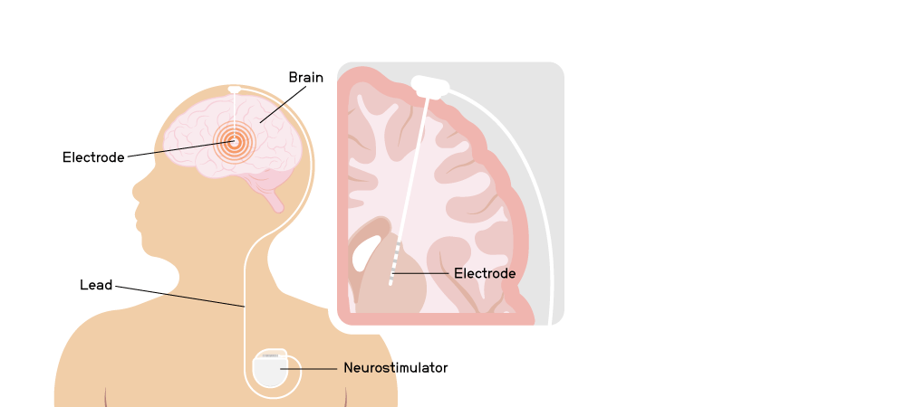 A graphic depicting the placement of Paradromics Connexus BCI